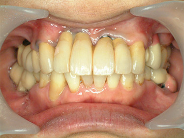 長い差し歯の症例